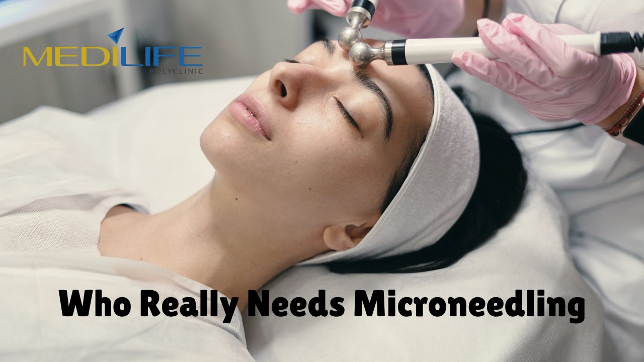 Microneedling treatment for Acne Scars in Dubai