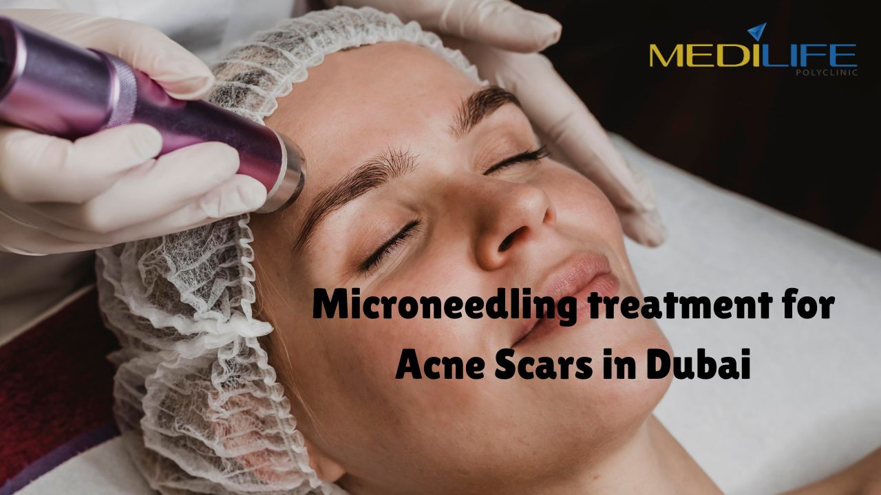 Microneedling treatment for Acne Scars in Dubai